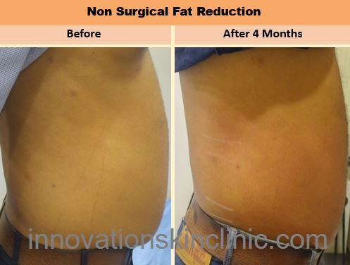 Fat Reduction 1